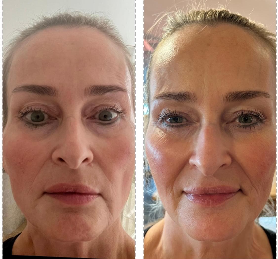 Dermal filler treatment before and after results