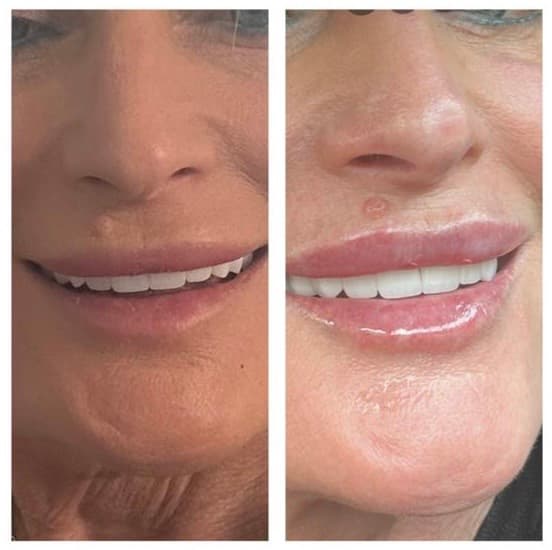 Botox treatment before and after results